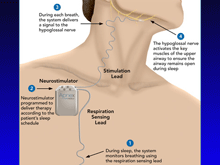 Apnex Medical
